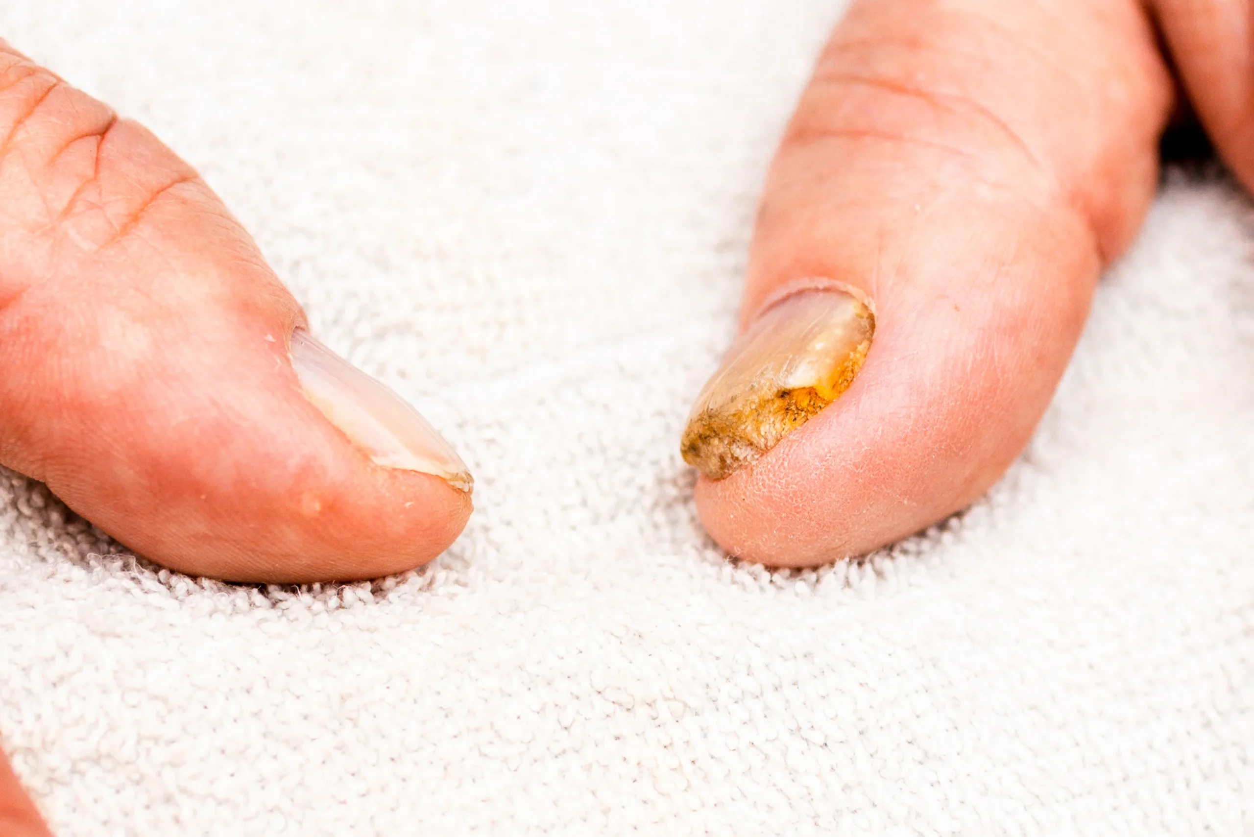 Before and after photo showing yellow nails transformed into bright, healthy nails.
