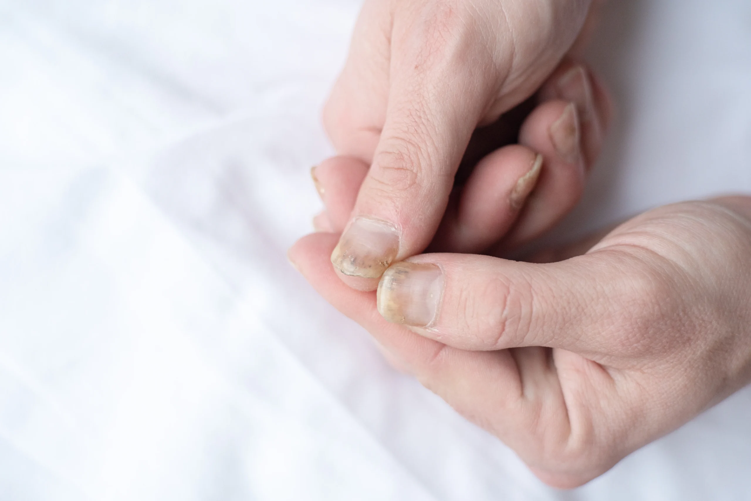 Natural remedies for yellow nails