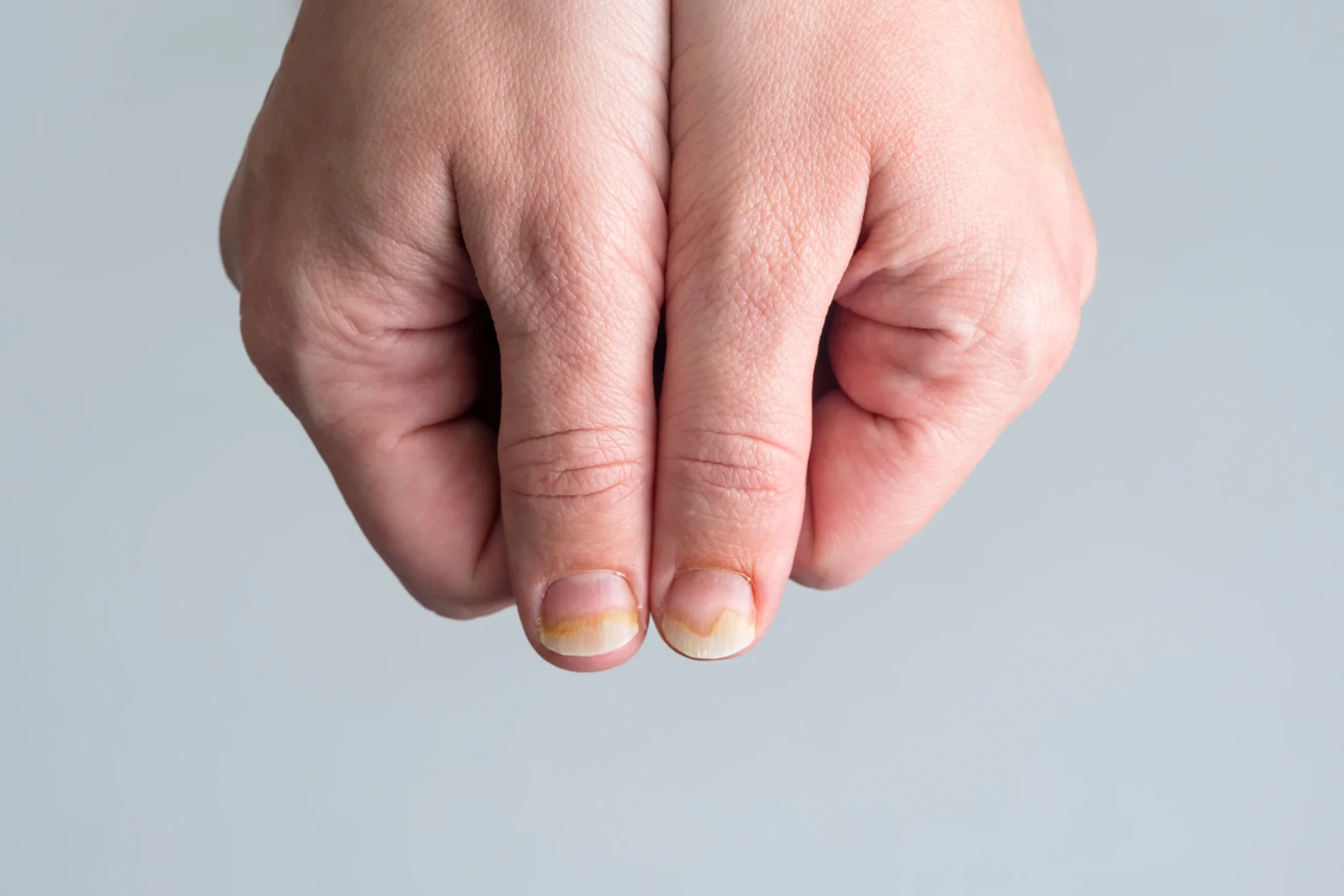 Close-up of yellow nails after nail polish removal with natural remedies shown.